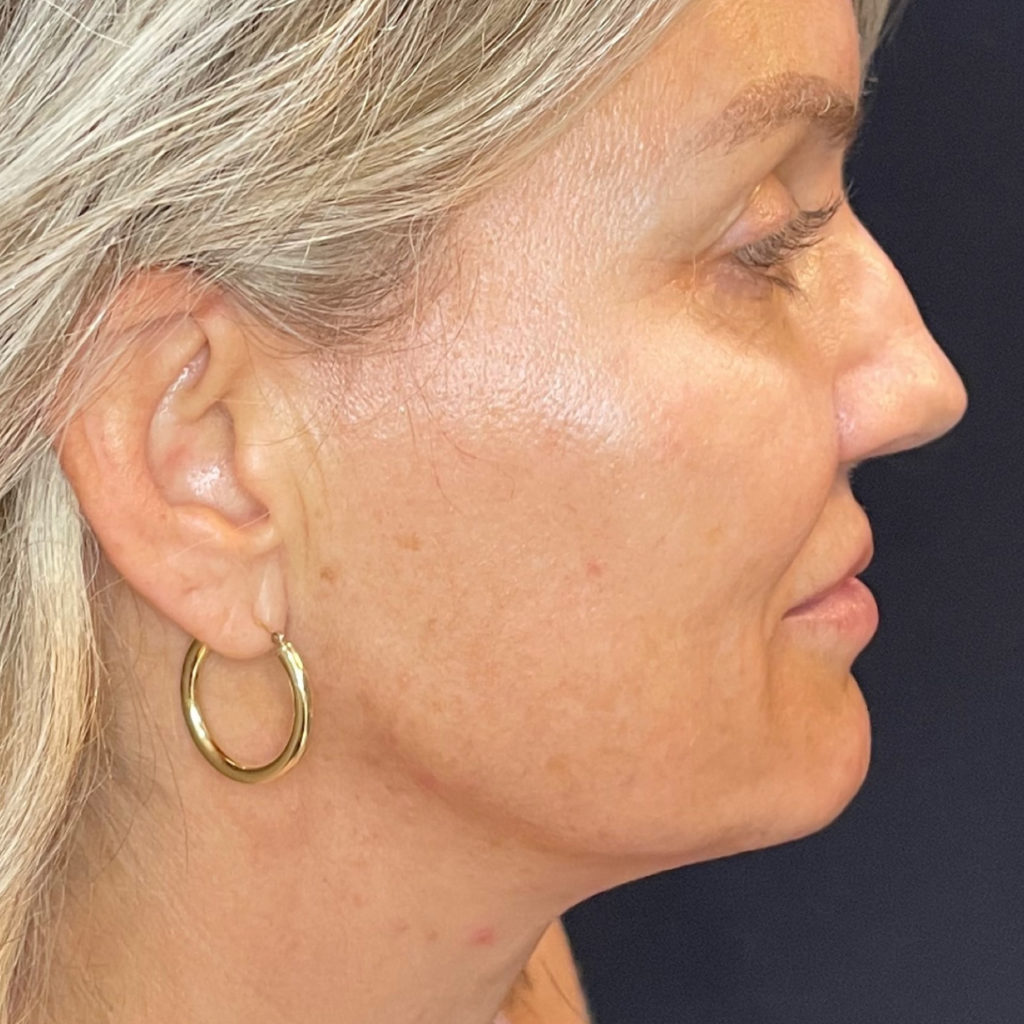 Dermal Fillers Winter Park