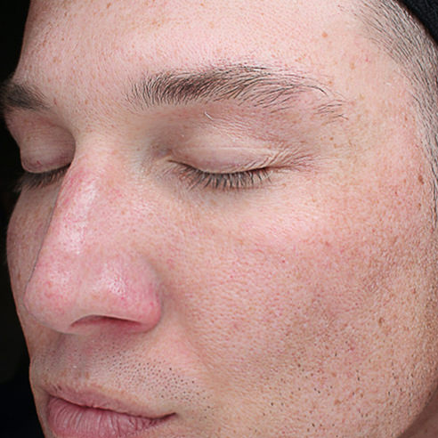 Chemical Peels After