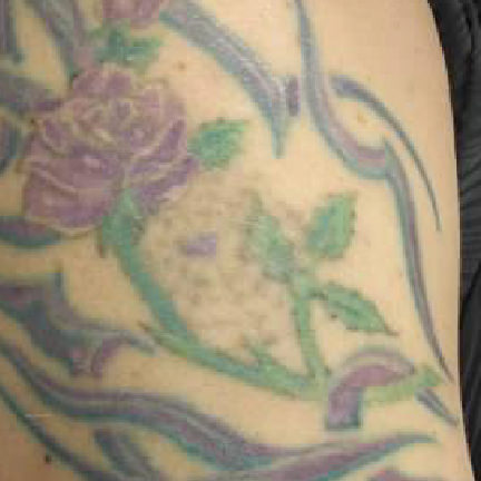 Medermis Tattoo Removal Before