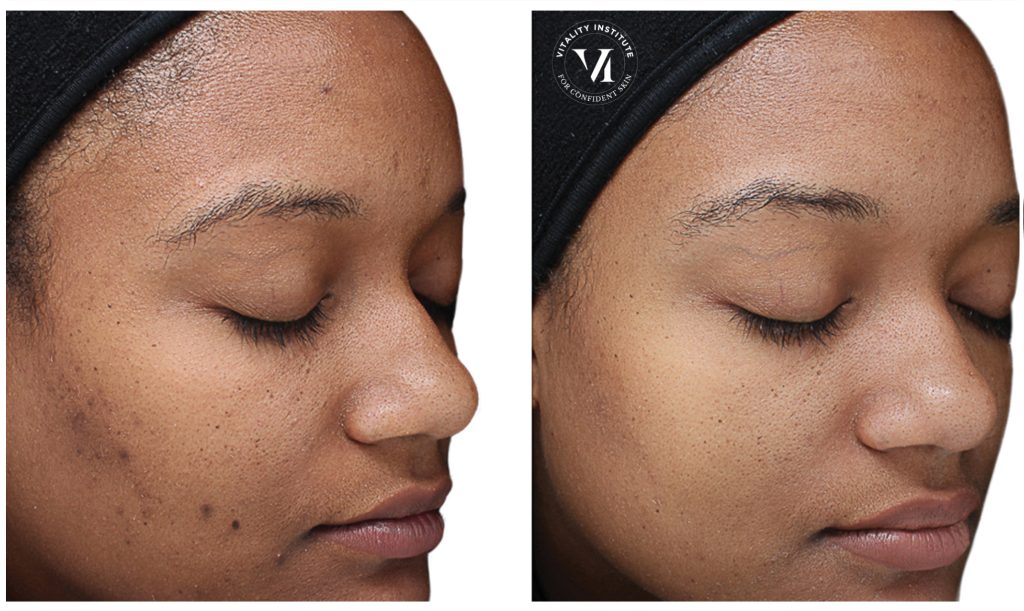 Before and After of Chemical Peel for Pigmentation on dark skin