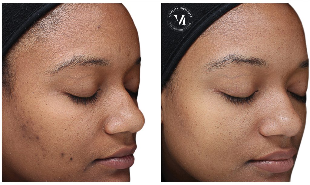 Chemical Peel Before & After