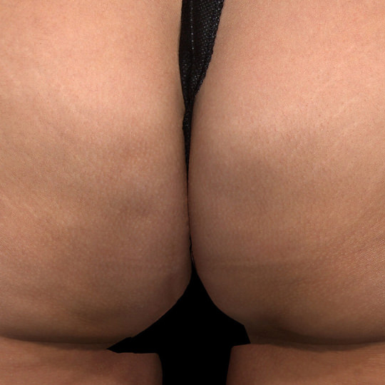 QWO Moderate to Severe Cellulite After