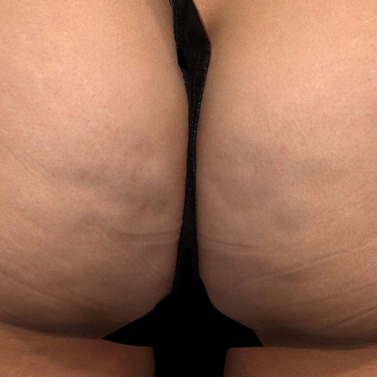 QWO Moderate to Severe Cellulite Before