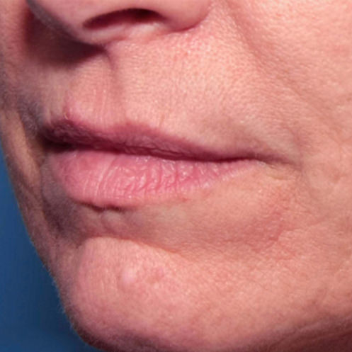RF Microneedling After
