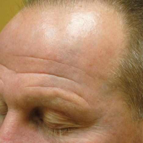 Forehead Tattoo Removal Orlando Treatment After