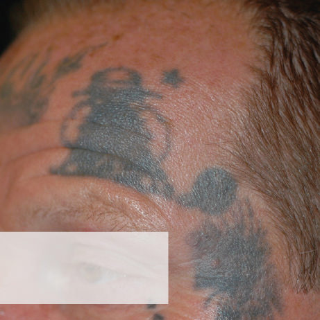 Forehead Tattoo Removal Orlando Treatment Before