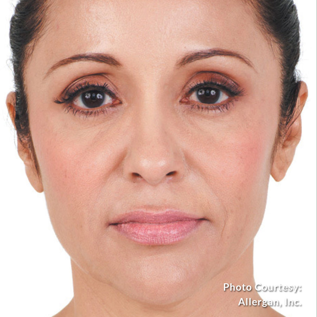 Injectable Filler After