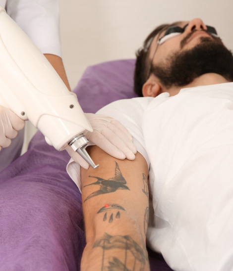 Man Undergoing Tattoo Removal Orlando Treatment