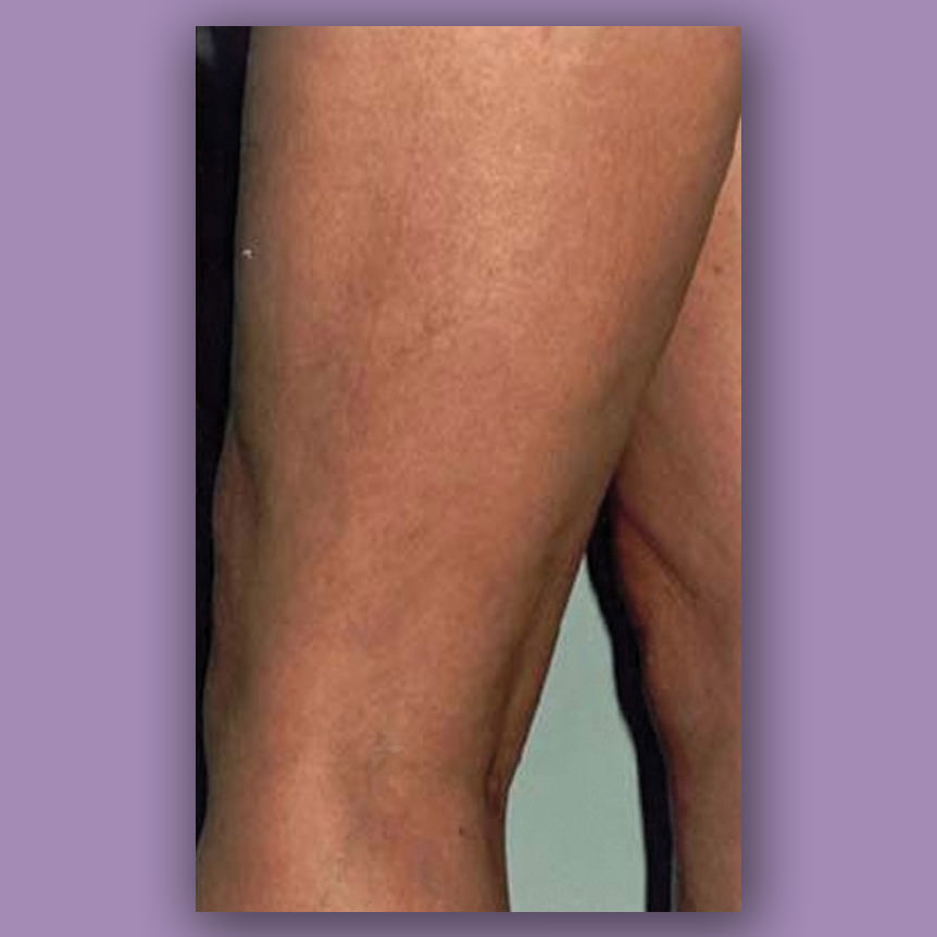 spiderveins after treatment