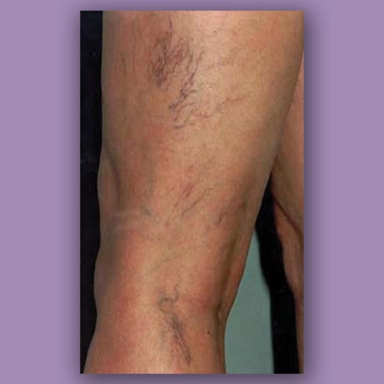 Laser Vein Removal Orlando Laser Vein Treatment