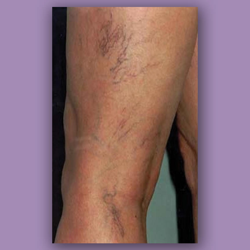 spiderveins before treatment