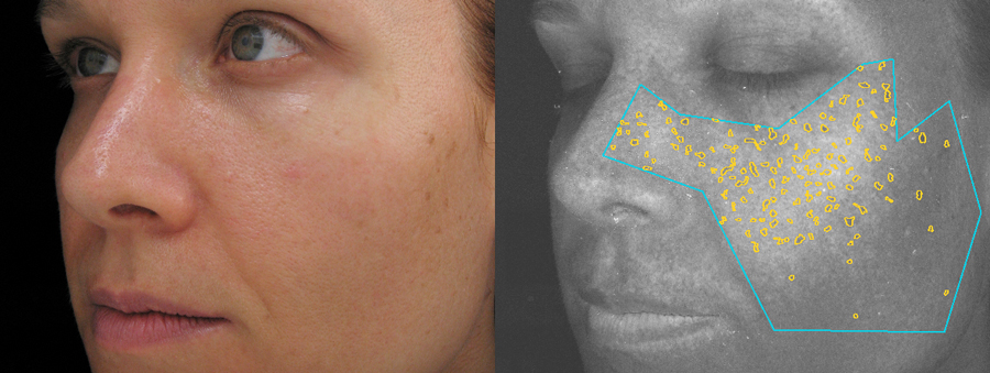 VISIA Skin Alanlysis UV-Comparison
