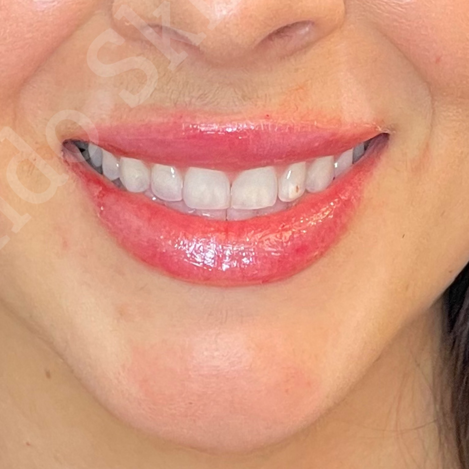 We’ll create a personalized Lip Filler Winter Park treatment plan that complements your facial features.